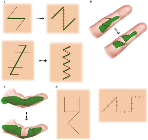 essential aspects  transposition flaps   plasties