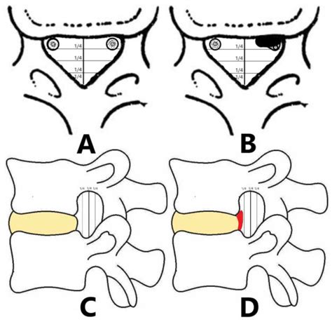 Clinical Characteristics Of Minimal Lumbar Disc Herniation And Efficacy