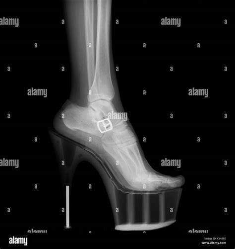 High Heel X Ray