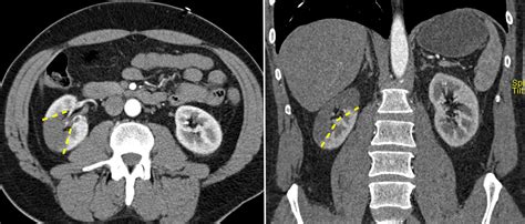 Renal Infarct Secondary To Atrial Fibrillation Radiology At St Vincents University Hospital