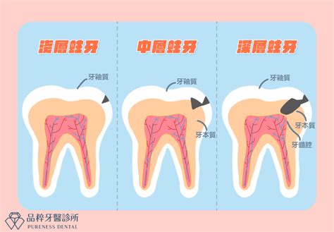 蛀牙太深不想根管抽神經？選活髓治療好嗎？ 品粹牙醫