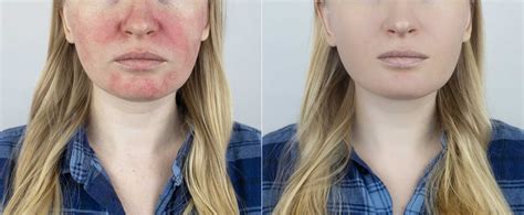 Rosacea Hautarzt Dr Dauer Ihr Dermatologe In K Ln