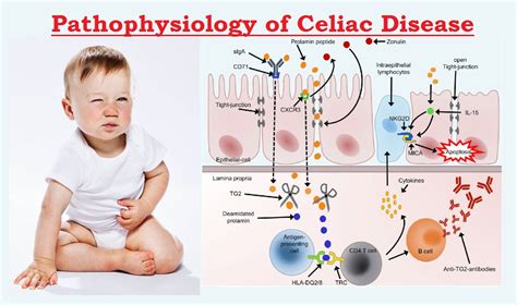 Celiac Disease Sign And Symptoms Risk Factors Diagnosis