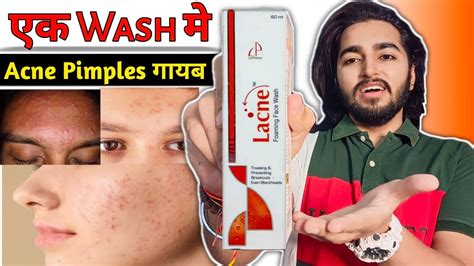 Blackheads Whiteheads Acne Clear Face Wash Review Face Wash For Oily Acne Prone Skin Youtube