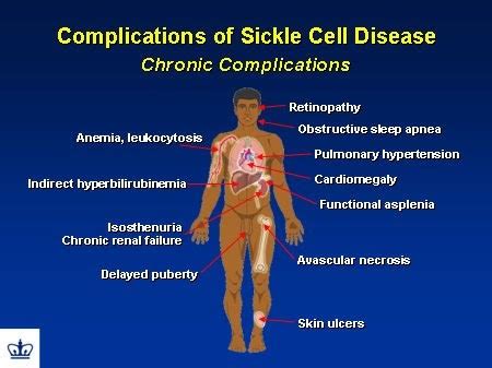 Medical Adda: Complications of Sickle cell disease...