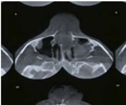 Opaque Maxillary Sinus Due To Fracture And Severing Of Alveolar Antral