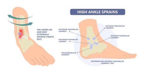 Ankle Syndesmosis Injuries