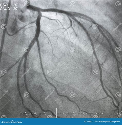 Coronary Angiography X Ray Image Stock Image Image Of Diagnosis