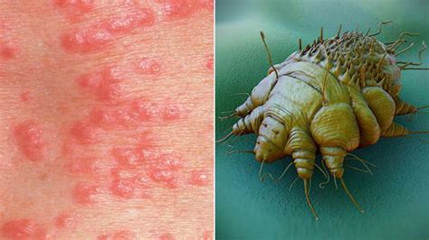 How To Cure Scabies In One Day Preparations Against Scabiesbenzyl