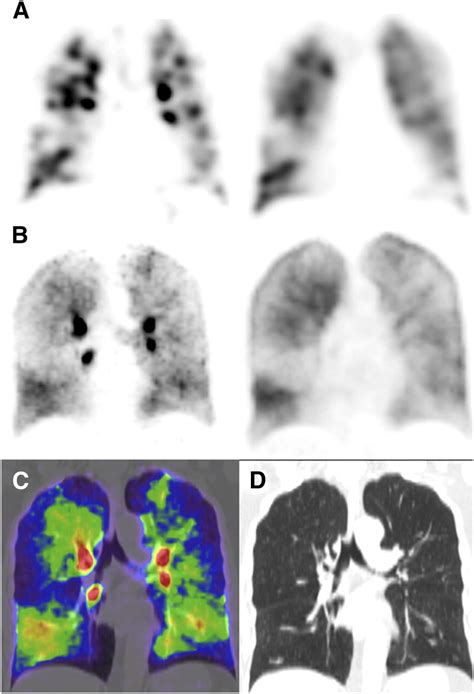 68Ga PET CT VentilationPerfusion Imaging For Pulmonary Embolism A