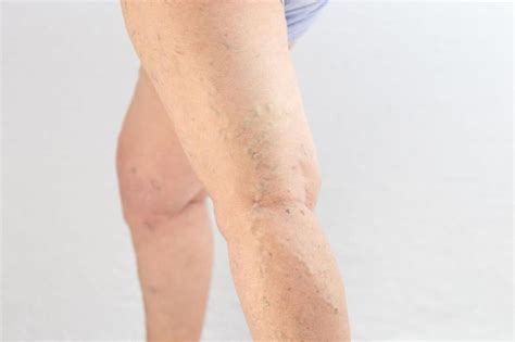 Complications Of Untreated Varicose Veins You Should Know Vein Envy