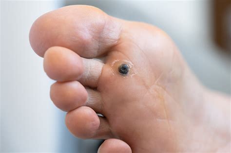 Plantar Warts Understanding The Causes And Removal Techniques