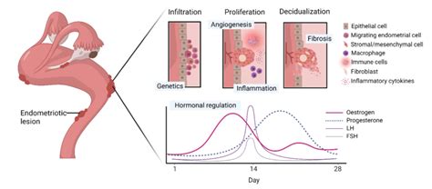 Schematic Diagram Of An Endometriosis Lesion Infiltration Onto Nearby