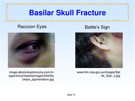 Basilar Skull Fracture Signs