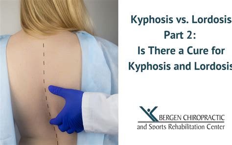 How Long Does It Take To Correct Kyphosis Bergen Chiropractic