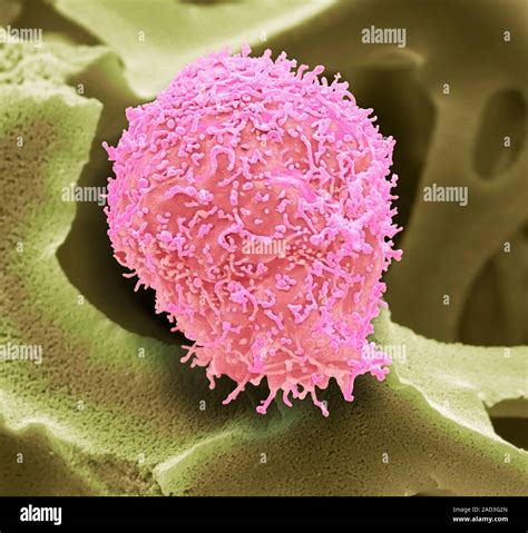 Cervical Cancer Cell Coloured Scanning Electron Micrograph Sem Of A