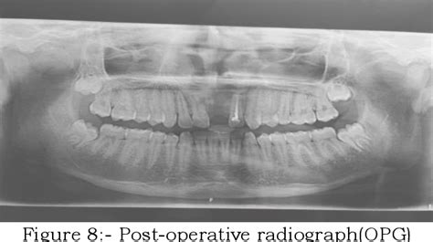 Figure 1 From Radicular Cyst Associated With Maxillary Anterior Tooth Treated With Conservative