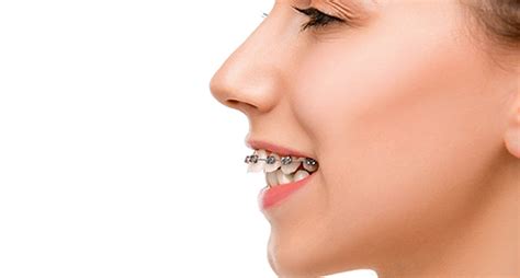 An Ultimate Guide to Overbite Braces!