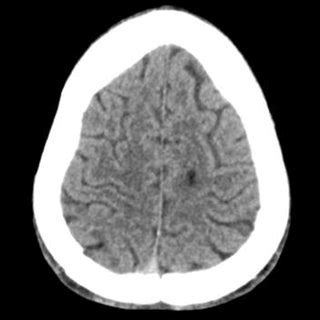 One Month Follow Up Non Contrast Brain Ct Scan Axial Image Shows Low