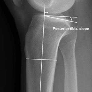 For The Measurement Of The Posterior Tibial Slope The Anatomical Axis