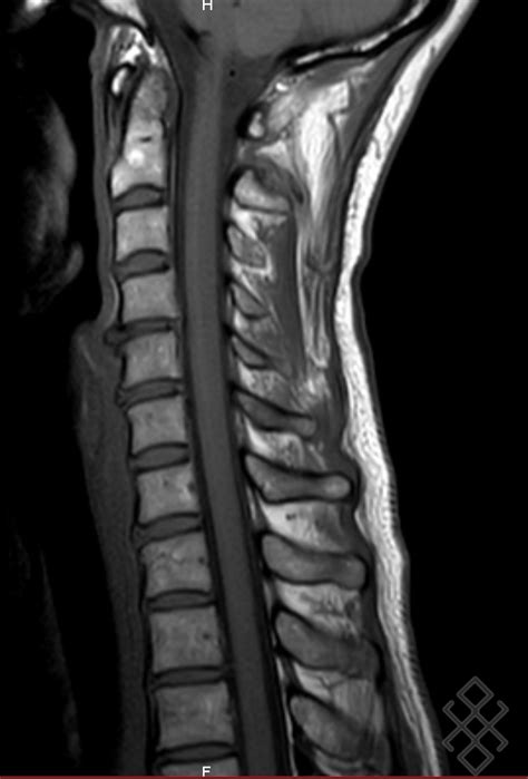 Irm Du Rachis Cervical D Finition D Roulement Prise De Rdv En Ligne