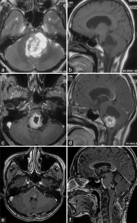 Intrinsic Brainstem Schwannoma A Rare Clinical Entity And A