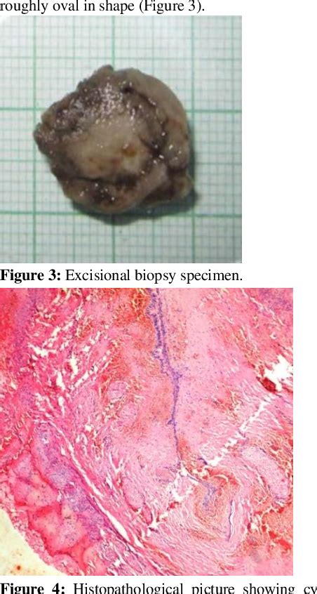 Figure 1 From Nasopalatine Duct Cyst A Case Report And Review Of