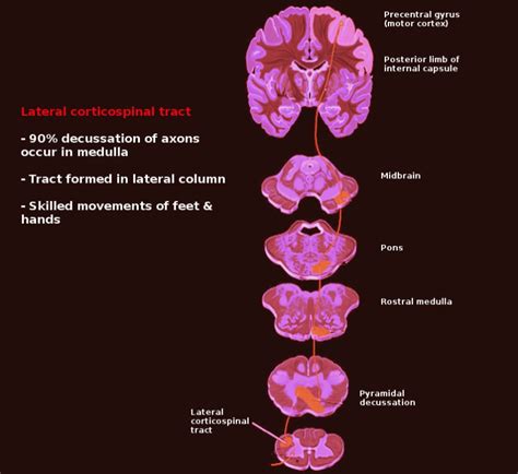 Neuroanatomy Pyramidal Tract Lesions Statpearls Ncbi Bookshelf