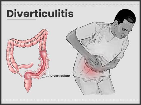 Diverticulitis Symptoms Causes Diagnosis And Treatment