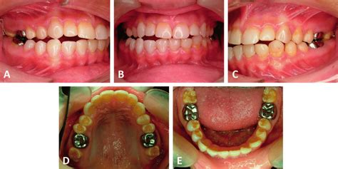 Intraoral Views Before Orthodontic Treatment A Right Side View B