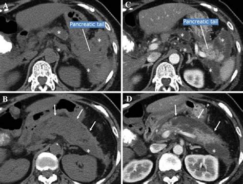 Necrotizing Pancreatitis And Fat Necrosis The Enlarged Pancreatic Body Download Scientific