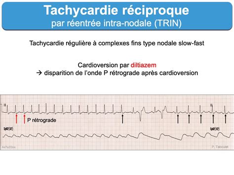 Inhibiteurs calciques (non-dihydroP) : e-cardiogram