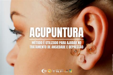 Acupuntura Para Ansiedade Pontos RETOEDU