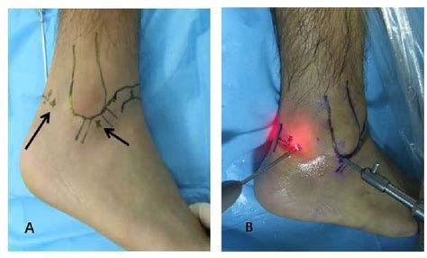 Figure 2 From Safety And Clinical Efficacy Of Double Posterolateral