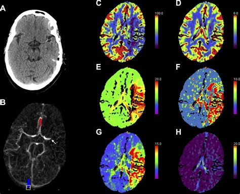 Interpreting Ct Perfusion In Stroke Practical Neurology