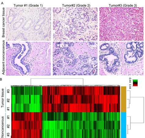 The Mrna Profile Differentiates Breast Cancer Tissue From Adjacent