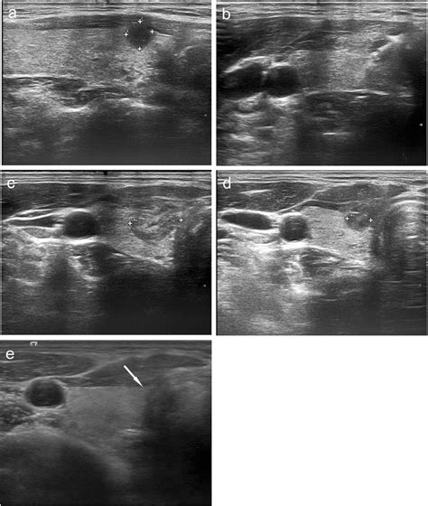 A 39 Years Old Woman Had A Nodule Diagnosed As Papillary Thyroid