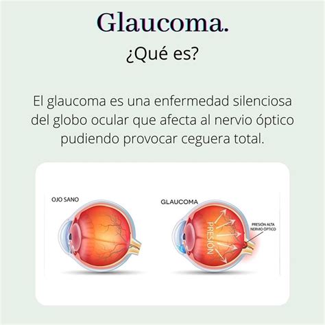 Glaucoma cómo prevenirlo Noticias