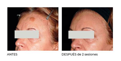 Eliminación De Manchas Faciales Con Peeling Químico Clínica Fontana