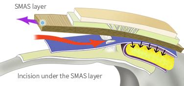 SMAS Facelift in Korea - JW Plastic Surgery