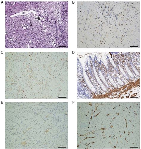 Pathological Examination Of The Tumors A Histology Indicated That