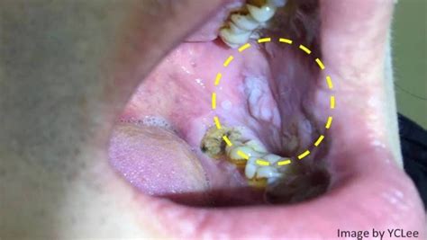 有圖》嘴巴這兩種「斑」可能變口腔癌！耳鼻喉科醫師：常見的3種癌前病變 照護線上 良醫健康網
