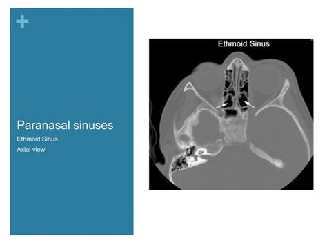 Nasal Cavity And Paranasal Sinuses Radiologic Anatomy Ppt