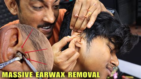 Massive Earwax Removal From Ear Ear Cleaning With Earbuds Head