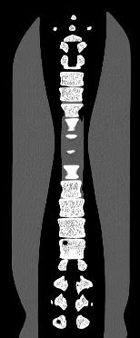 Columna Vertebral Adulta Para Radiograf A Tomograf A Computarizada