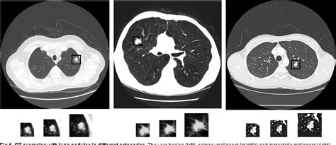 Figure From D Multi View Convolutional Neural Networks For Lung