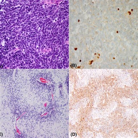 Cns Fibroblastic Tumor With Ntrk Rearrangement A Spindle Cell