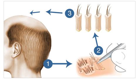 Hair Loss Solution Fue Hair Transplant Dr Chen Tai Ho Malaysia