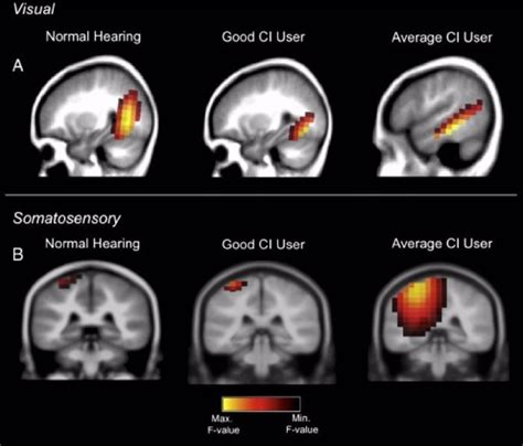 El cerebro se reorganiza tras una pérdida de la audición