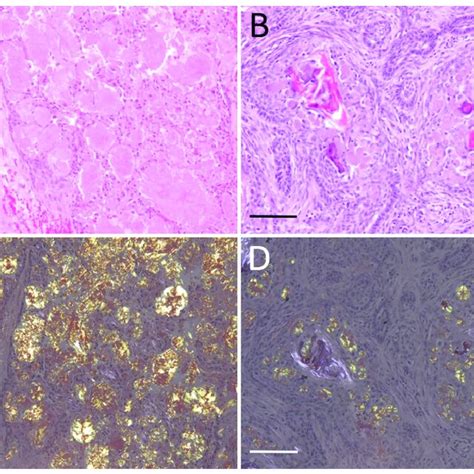 Amyloid Producing Ameloblastoma Apab A Apab Dog No 3 Cystic